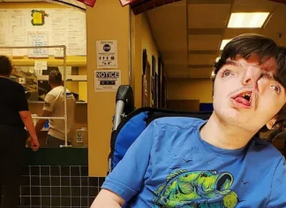 Boy with two faces celebrates 18th birthday, doctors say it is difficult to survive Boy with two faces celebrates 18th birthday, doctors say it is difficult to survive