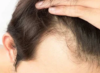 Hair fall in men, you can also stop hair fall, just follow these things Hair Fall In Men: ...तर तुमचीही केस गळती थांबू शकेल, फक्त या गोष्टी पाळा