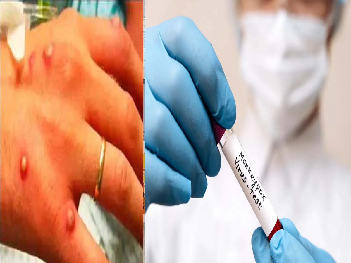 Monkeypox cases jump 20 percent, 7,500 new cases raise WHO concern

