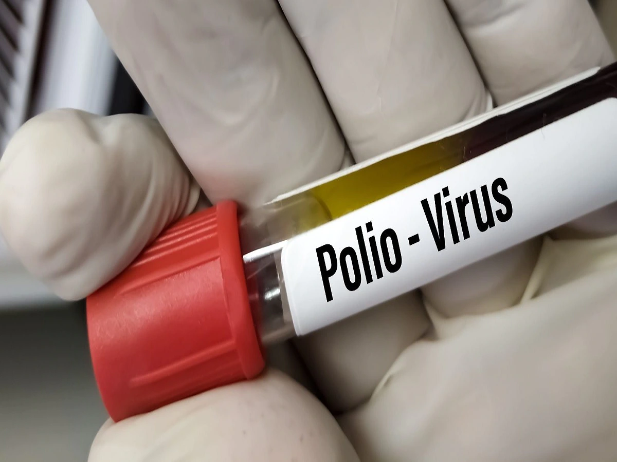 Polio virus found in the sewage of New York, officials said - the disease spread silently

