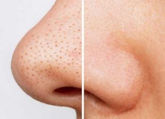 The problem of blackheads Are you troubled by blackheads then do these remedies NZ The problem of blackheads Are you troubled by blackheads then do these remedies NZ