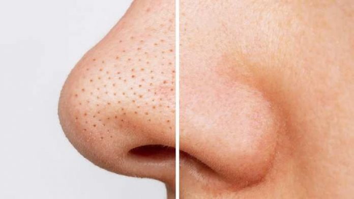 The problem of blackheads Are you troubled by blackheads then do these remedies NZ

