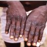 Worldwide 50-thousand-cases-monkeypox-raised-anxiety-who-issued-alert