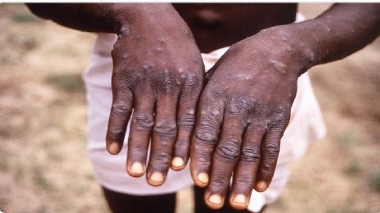 Worldwide 50-thousand-cases-monkeypox-raised-anxiety-who-issued-alert

